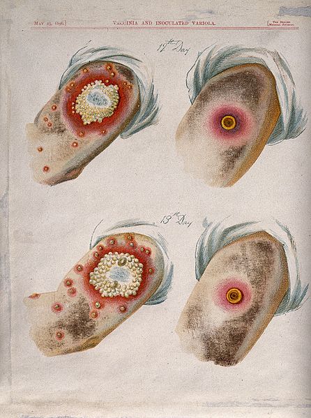 A_comparison_between_smallpox_and_cowpox_pustules_on_the_12t_Wellcome_V0016674